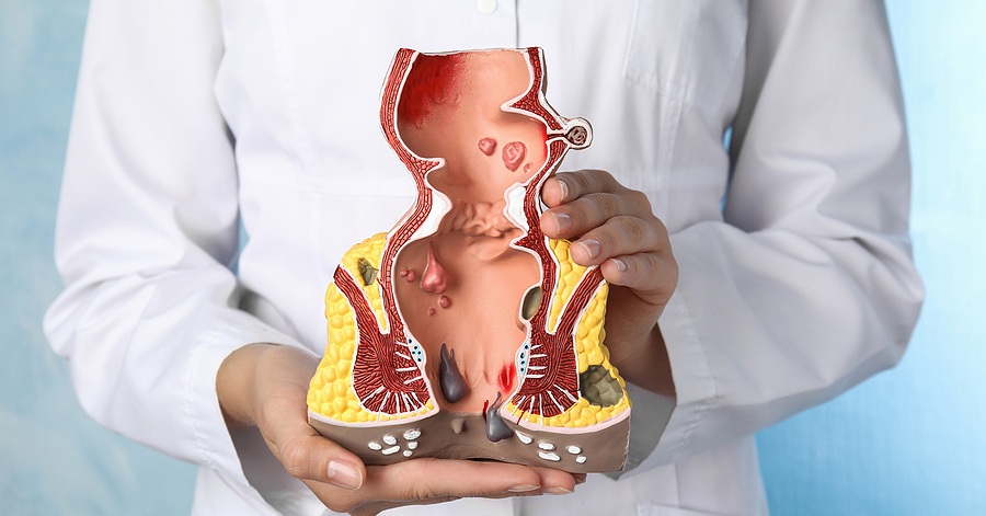 Anal fissure — tear in anal lining